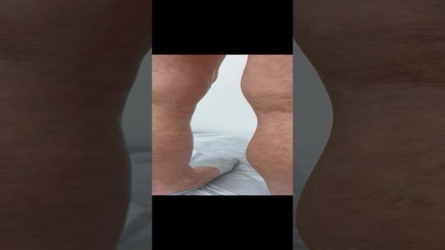 Пациентке предлагали операцию, которая ей не нужна. Узи сосудов. Флеболог Москва. Сосудистый хирург
