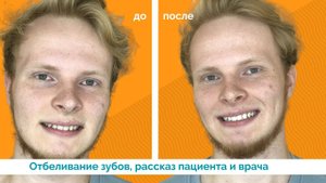 Отбеливание зубов Amazing White во Владимире. Рассказ пациента.