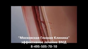 Влажная форма ВМД (возрастной макулярной дегенерации сетчатки)