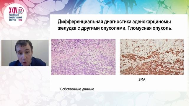 Опухоли желудка. Взгляд морфолога смотреть онлайн