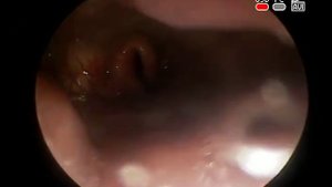 #Киста глотки и #гортани #ЛОР эндоскопия КЛИНИКА ОБРАЗЦОВА Диагностика лечение