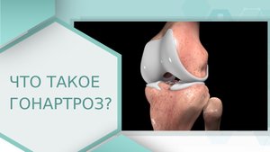 ⁇ Что такое гонартроз (или артроз коленного сустава)? Что такое гонартроз коленного сустава. 18+