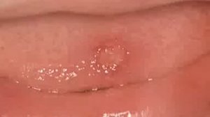 Дентал фэнтези  О стоматите у детей