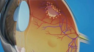 Дистрофия сетчатки по типу след улитки - нужно ли делать лазерную коагуляцию и рожать самой?