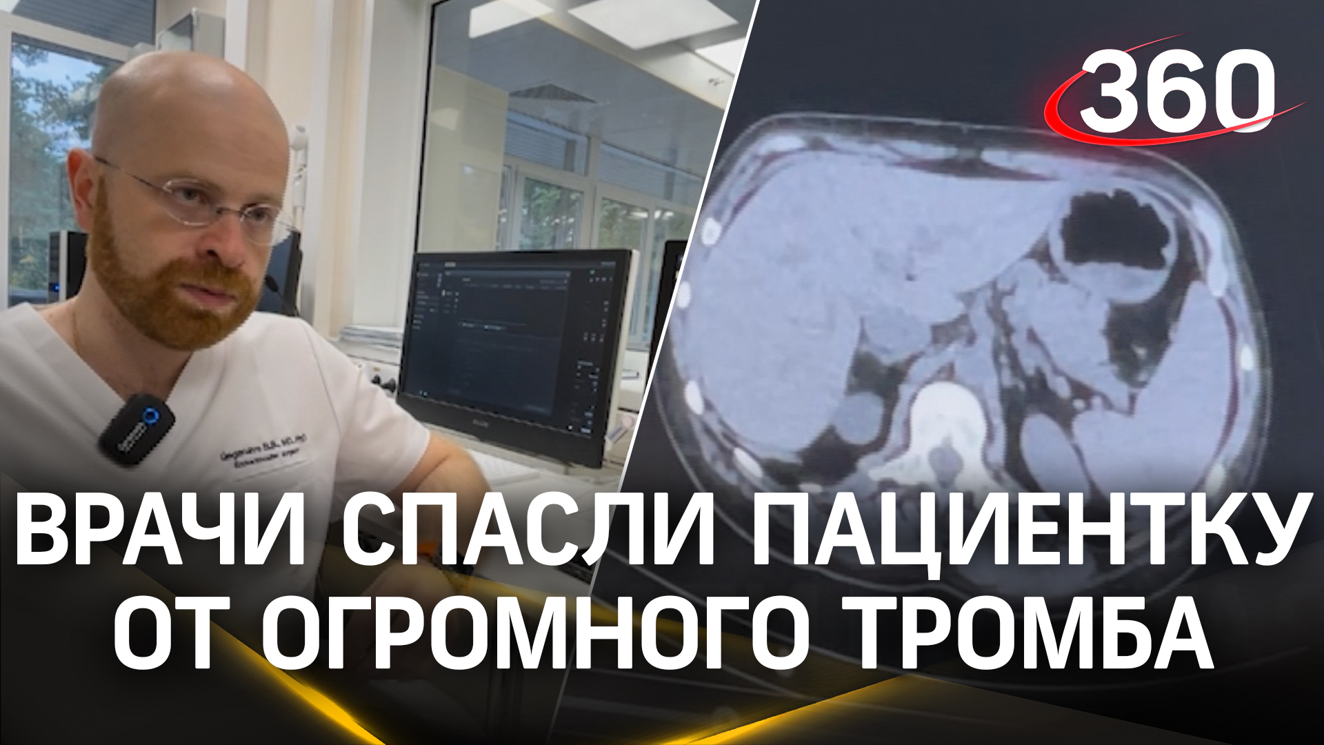 Врачи в Жуковском удалили тромб длиной 7 сантиметров