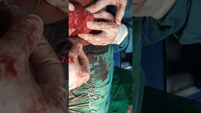 Hayman Compression Suture  Alternative to B-Lynch