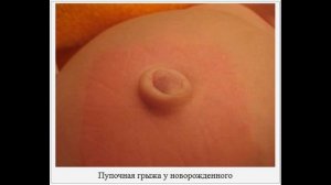 Пупочная грыжа у ребенка// Чем лечить грыжу