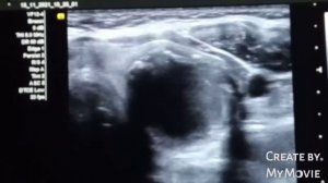 TIRAD 5 thyroid nodule | suspicious | ultrasound case