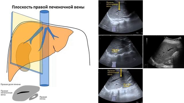 !Плоскости УЗ сканирования печени БФУ ПП смотреть онлайн