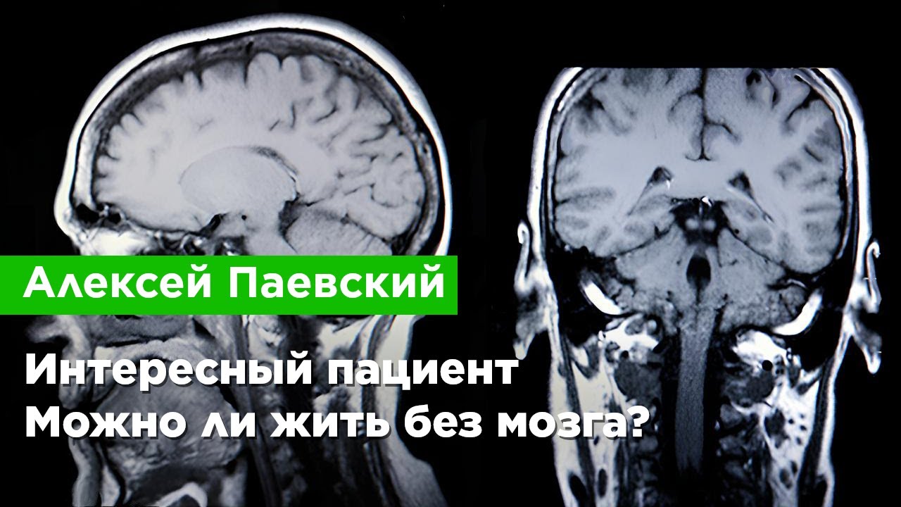 Алексей Паевский — Интересный пациент. Можно ли жить без мозга?