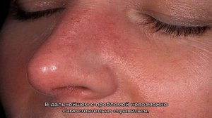 Красное лицо у женщины: причины