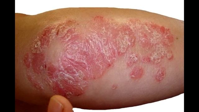 Заразен ли псориаз кожи для окружающих? смотреть онлайн