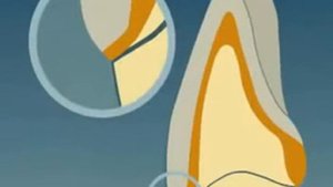 Металлическая коронка.