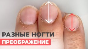 Ногти для медсестры | Исправляем разные ногти | Наращивание