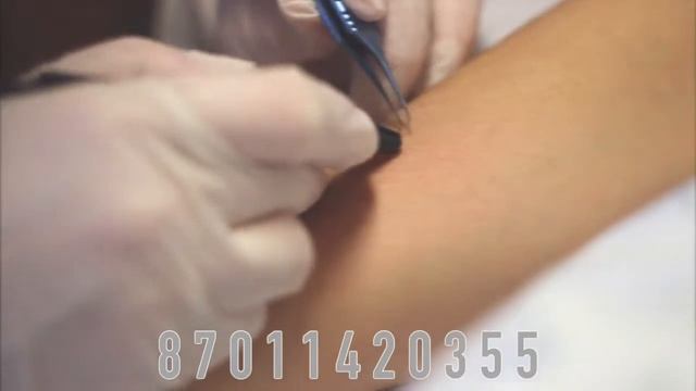 Электроэпиляция