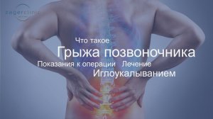 Что такое грыжа позвоночника | Лечение иглоукалыванием
