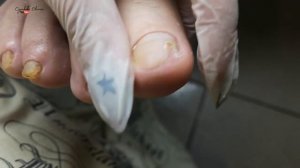 Утолщение ногтей и онихолизис из-за деформации пальцев ног. Зачистка онихолизиса и педикюр пальцев