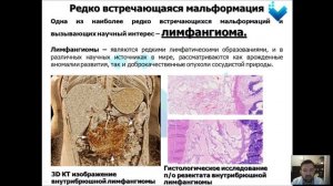 Лимфангиома, доклад на конференцию 29.11.2021 г.