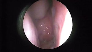 Гипертрофия аденоидов