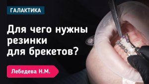 Для чего нужны резинки для брекетов? | Лебедева Наталья Михайловна