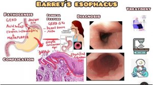 Barret’s Esophagus made simple for USMLE, NEET PG, NCLEX