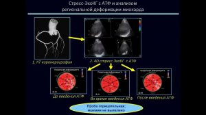 ЭхоКГ в выявлении ишемии при отсутствии значимого поражения магистральных коронарных артерий.