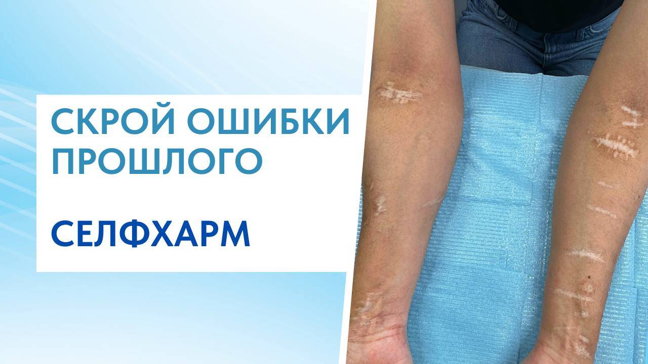 УБРАЛИ ШРАМЫ ИЗ ПРОШЛОГО | ПОМОГЛИ СКРЫТЬ ШРАМЫ ОТ СЕЛФХАРМ