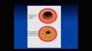 Как Бесплатно Вылечить Атеросклероз? | Доктор Майкл Клапер