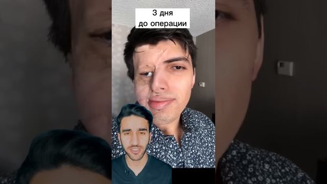 пластика лица после ожога