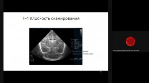 Ультразвуковая анатомия головного мозга новорожденных в норме Каркошка Т А