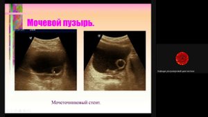 УЗ диагностика заболеваний мочевого пузыря и мочеточников