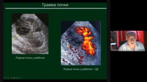 УЗД заболеваний почек Часть 3 зав каф проф Неласов Н Ю