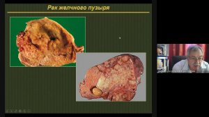 УЗД заболеваний ЖВП 2 Неласов Н Ю