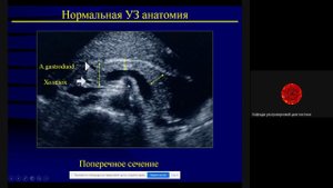 УЗД заболеваний поджелудочной железы  Ерофеева А В
