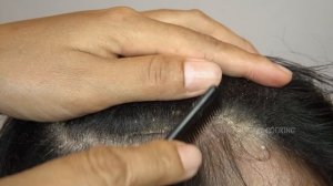 WOW! Huge Dandruff Flakes Scratching On Right Side #515