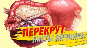 ПЕРЕКРУТ кисты яичника. Важная информация