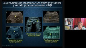 Лекция  УЗД заболеваний надпочечников Н Ю  Неласов