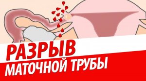 РАЗРЫВ МАТОЧНОЙ ТРУБЫ. Гидросальпинкс. Пиосальпинкс. Трубная беременность. ЧТО ДЕЛАТЬ?