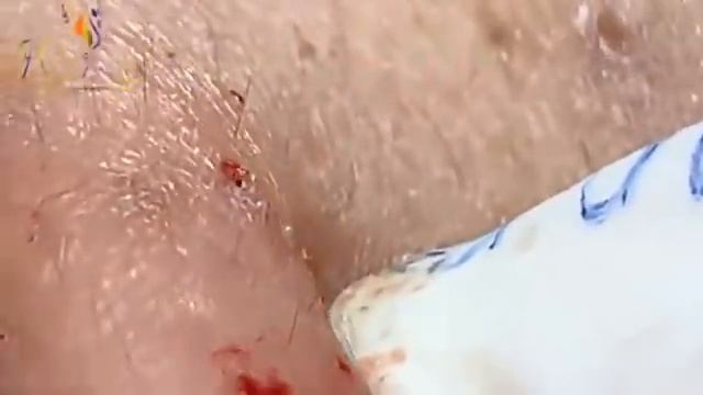 Hien Nguyen Acne #114 Relaxing Blackheads Removal смотреть онлайн