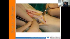 Newclip Faculty Live - Plantar Lapidus Arthrodesis: 10 years of hindsight - Dr Christoph H. Wilde