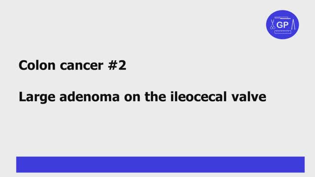 Colon cancer grossing #2 (pathology)