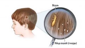 Как избавиться от мертвых и живых гнид, способы убрать их с волос