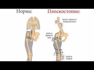 Базовое упражнение для работы с плоскостопием. Начинаем с 30 секунд и доводим за месяц до 300 секунд