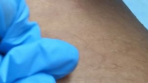 электроэпиляция