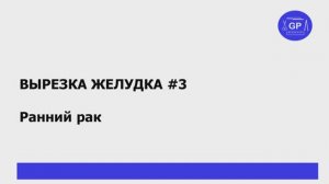 Ранний рак желудка - гистологическое исследование (вырезка) #3