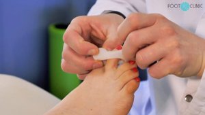 "Лечим" косточку на ноге без операции. #Footclinic