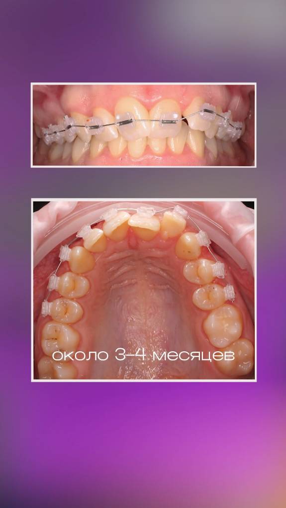 НЕВИДИМЫЕ брекеты #стоматология #зубы #dentist #orthodontist #брекеты