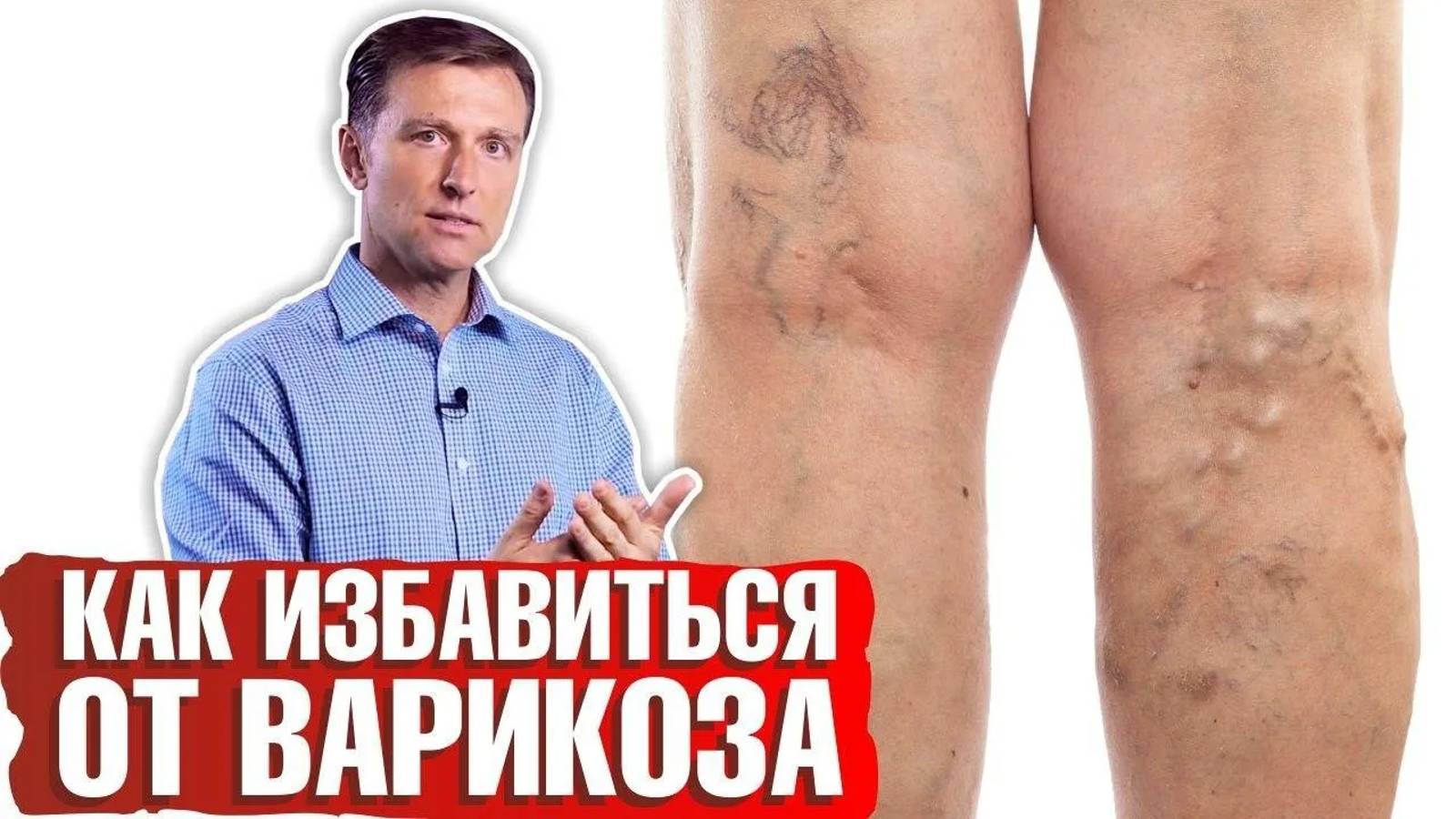 Варикозное расширение вен ► Какие причины возникновения варикоза и сосудистых звездочек?