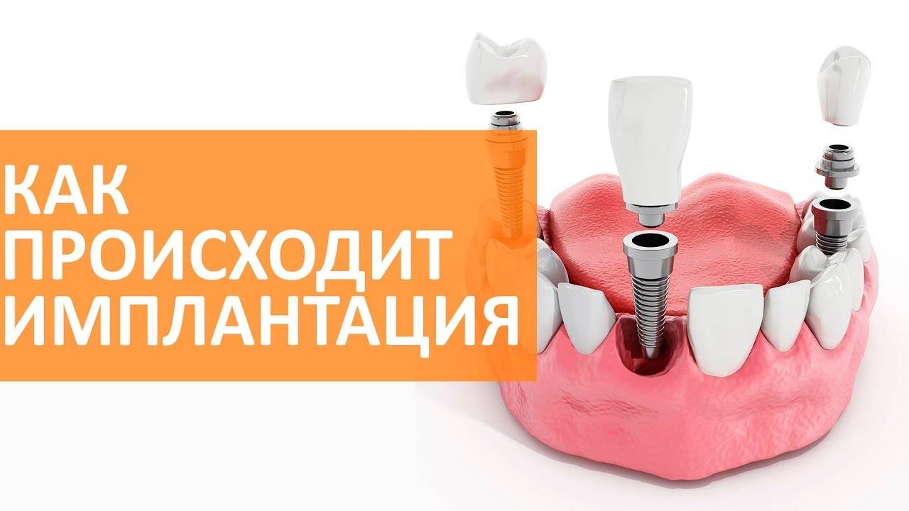 Имплантация зубов: основные этапы