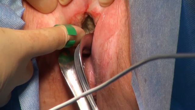 Electrochemotherapy procedure in Squamous Vulvar Cancer